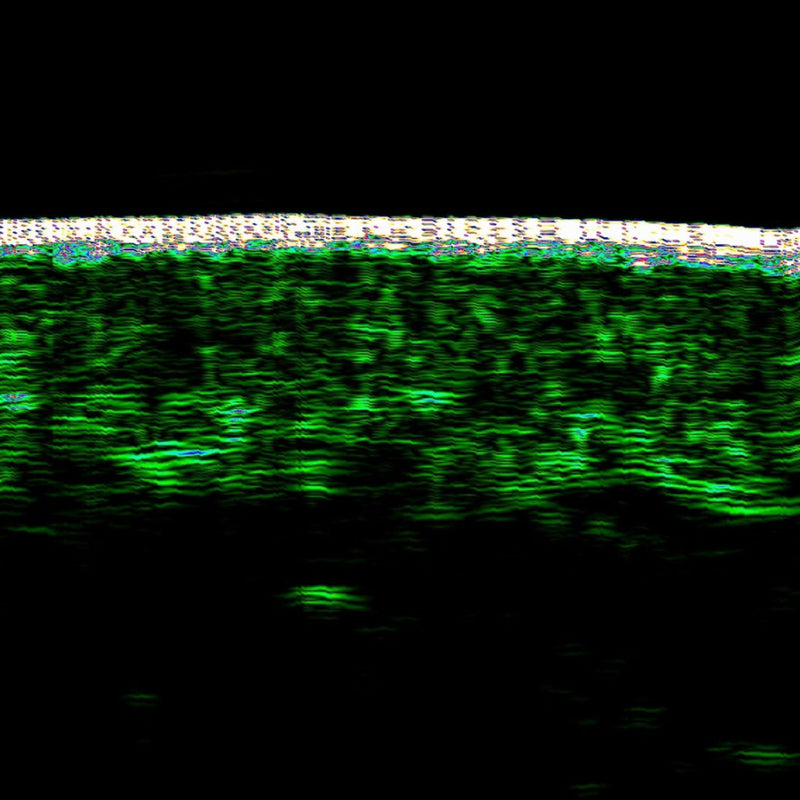Ultrasound -  Skin Density