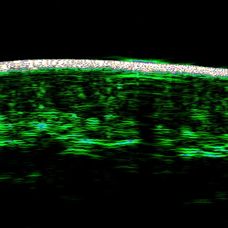 Ultrasound -  Skin Density