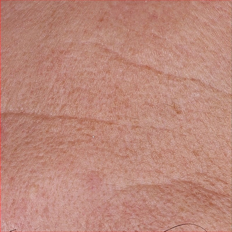 Wrinkles