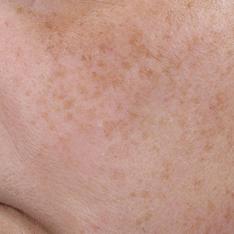Mexameter® — Pigmentation