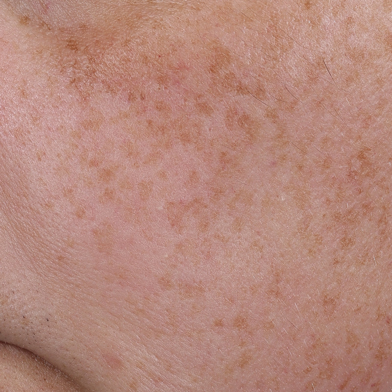 Mexameter® — Pigmentation