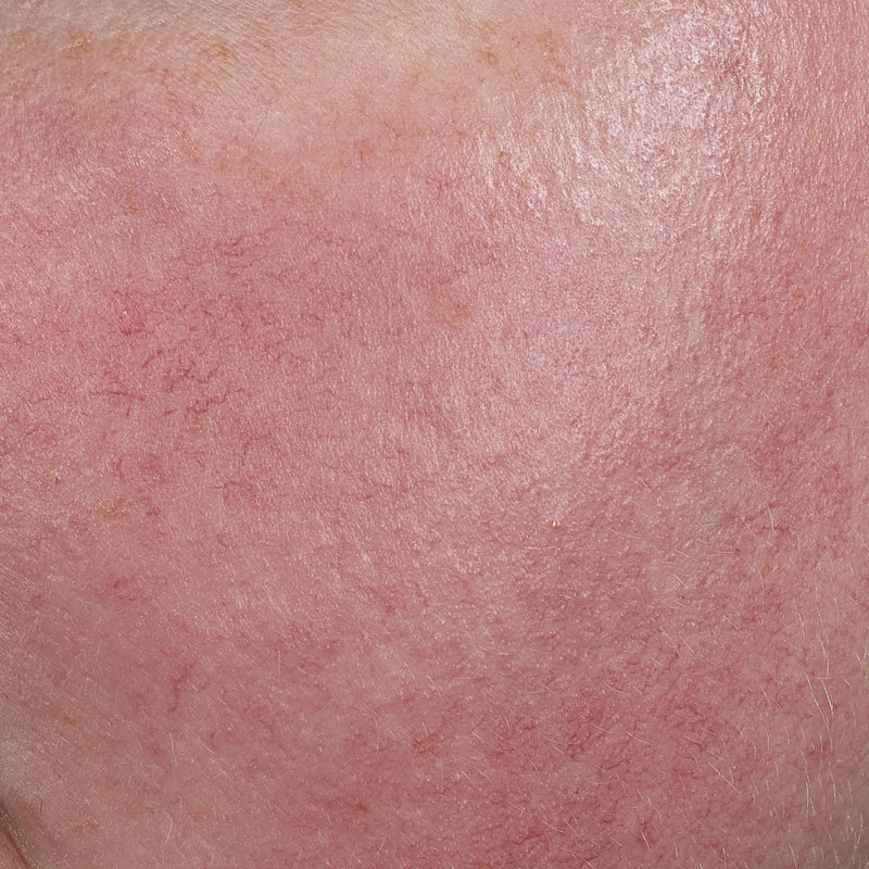 Mexameter® Skin Redness