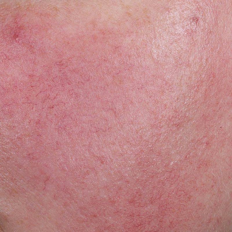 Mexameter® Skin Redness