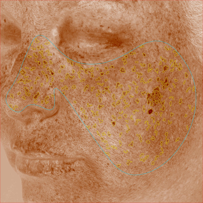 Brown Spots
