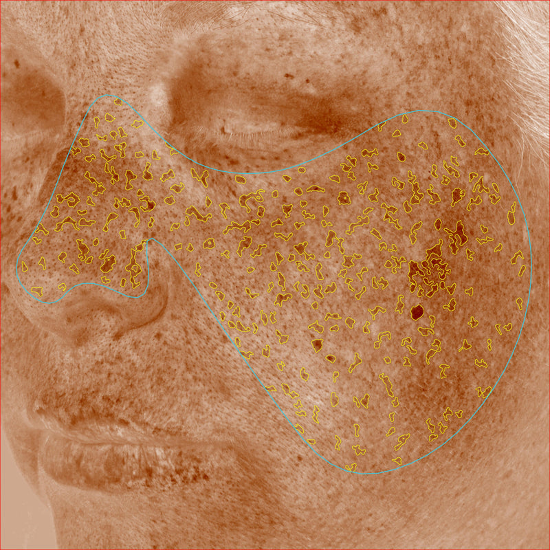 Brown Spots